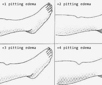 shin compression pitting edema test|pitting edema grade chart.